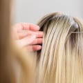 Hair Transplantation: The Ideal Solution For Hair Loss Following Laser Hair Removal In Beverly Hills