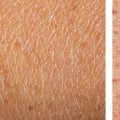Will laser hair removal help with strawberry legs?