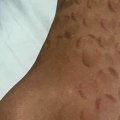 Can laser hair removal be damaging?