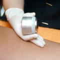 How do you know if your laser hair removal is working?