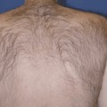 How does laser hair removal work on private parts?