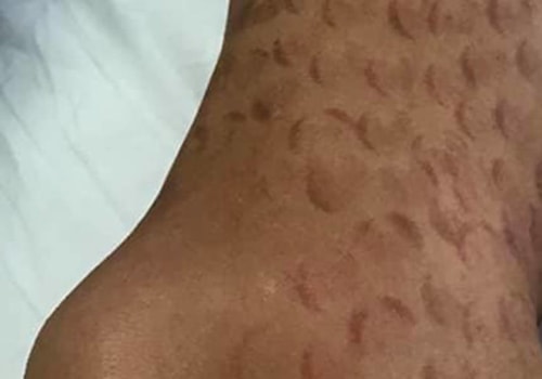 Are laser hair removal burns permanent?