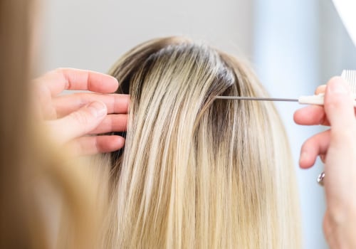 Hair Transplantation: The Ideal Solution For Hair Loss Following Laser Hair Removal In Beverly Hills