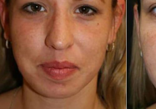 How many treatments does it take for laser hair removal to work?