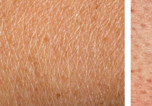 Will laser hair removal help with strawberry legs?