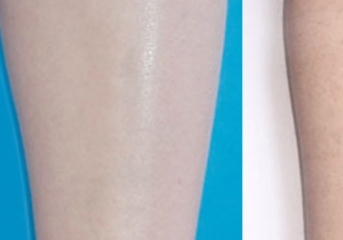How long after starting laser hair removal do you see results?