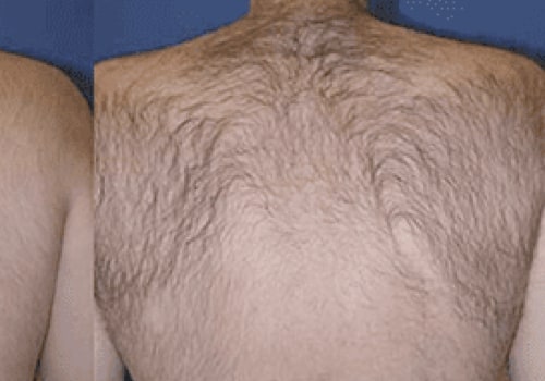 How does laser hair removal work on private parts?