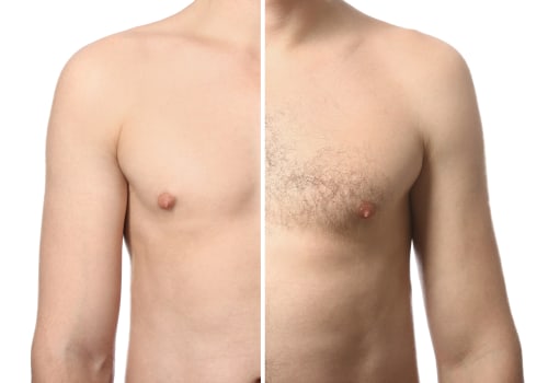 Achieve Smooth, Hair-Free Skin With Laser Hair Removal In Westlake Village